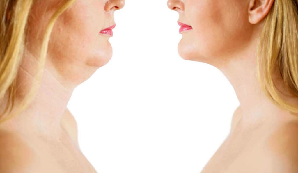 Double Chin treatment Lyndhurst before and after results