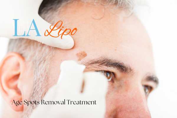 What Are the Most Effective Treatments for Age Spots Lyndhurst?