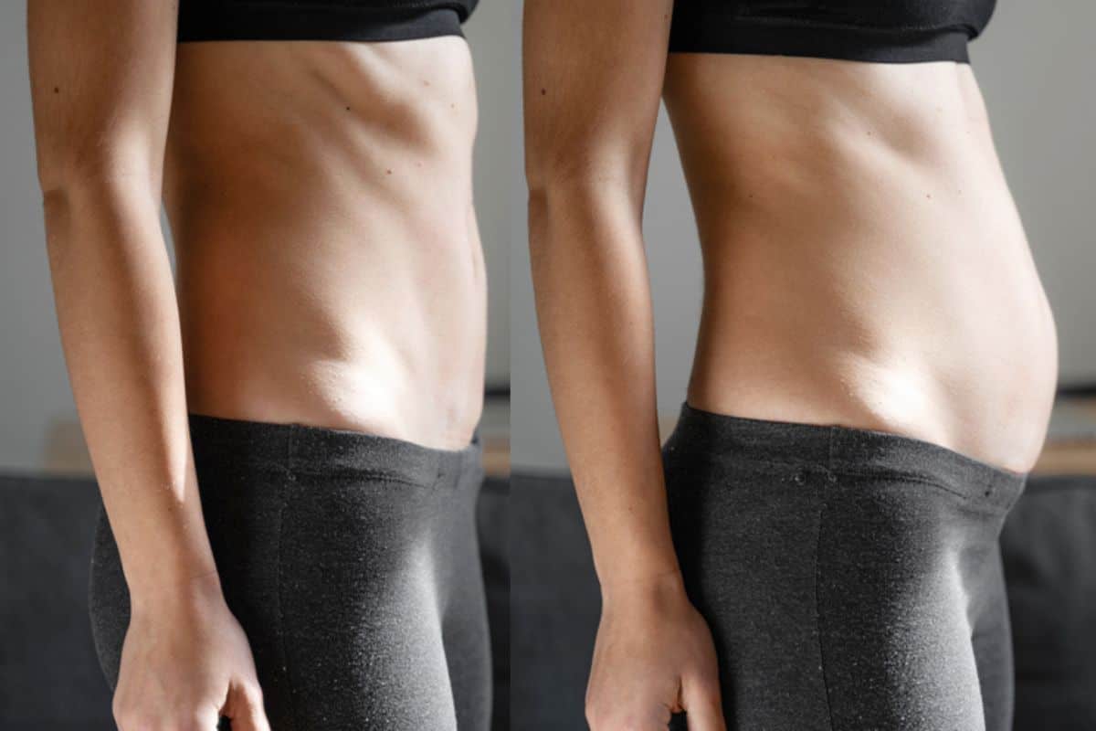 How long does diastasis recti take to improve Lyndhurst?