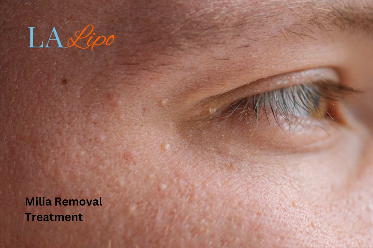 Cryopen Milia Removal: Is It the Easiest and Safest Option Lyndhurst?