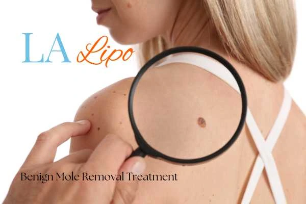 Woman having her inspection of blemish before mole removal Lyndhurst