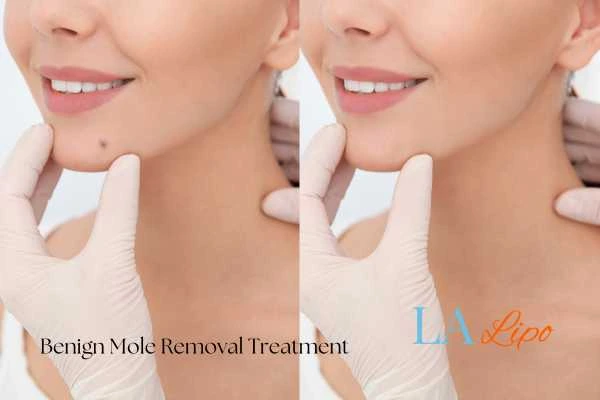woman's before and after mole removal Lyndhurst results