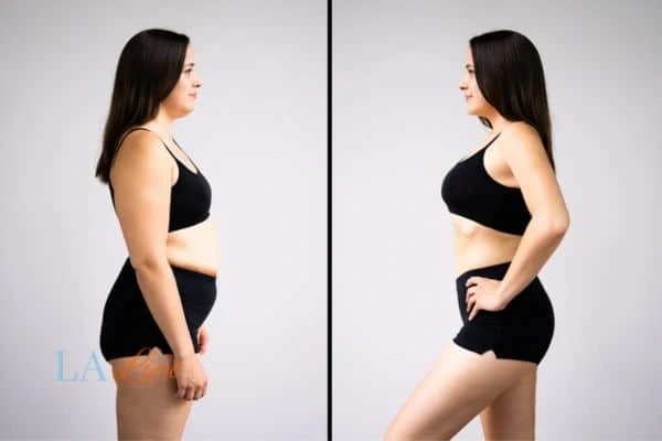 image of woman before and after results of LA-EMS Body Sculpting Lyndhurst to help treat Diastasis recti