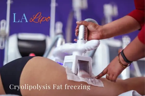 women getting fat freezing Lyndhurst
