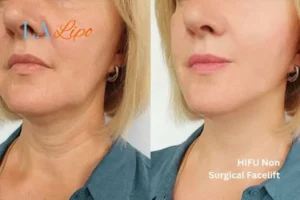 hi-fu for wrinkles Lyndhurst before and after results