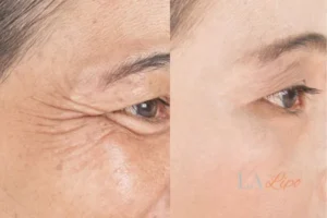 Before and after results of woman - HI-fu wrinkles reduction treatment Lyndhurst