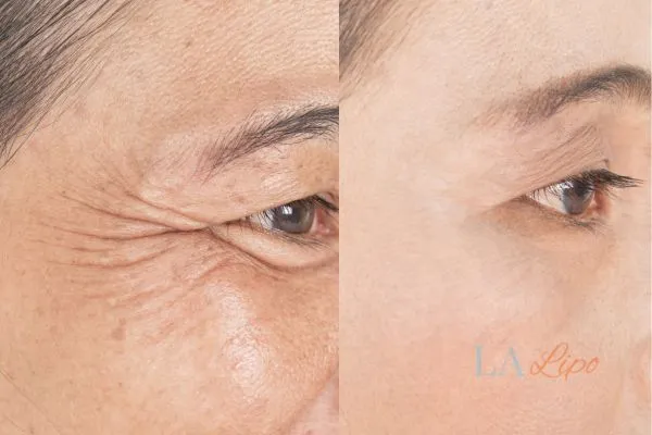 Before and after results of woman - HI-fu wrinkles reduction treatment Lyndhurst