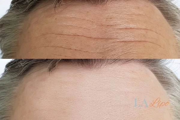 results of HIFU Lyndhurst on mans forehead to help reduce lines and wrinkles