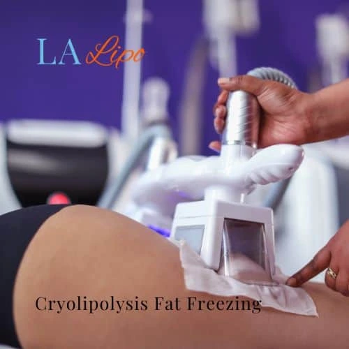 fat freezing - Cryolipolysis Lyndhurst