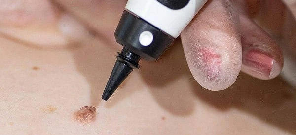 skin tag removal using cryopen Lyndhurst