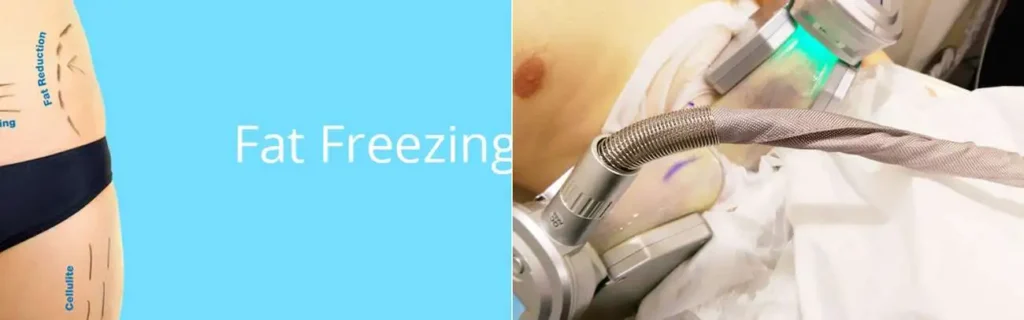 multi areas of a persons body having coolsculpting Lyndhurst treatment