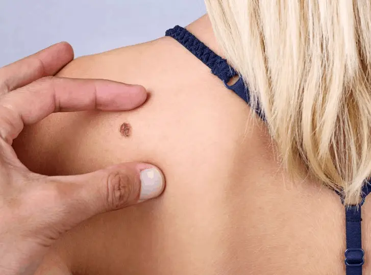 woman having mole removal Lyndhurst consultation before treatment.