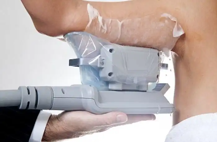 Picture of fat freezing Lyndhurst on the upper arms.
