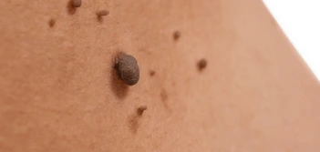 image of a skin tag Lyndhurst