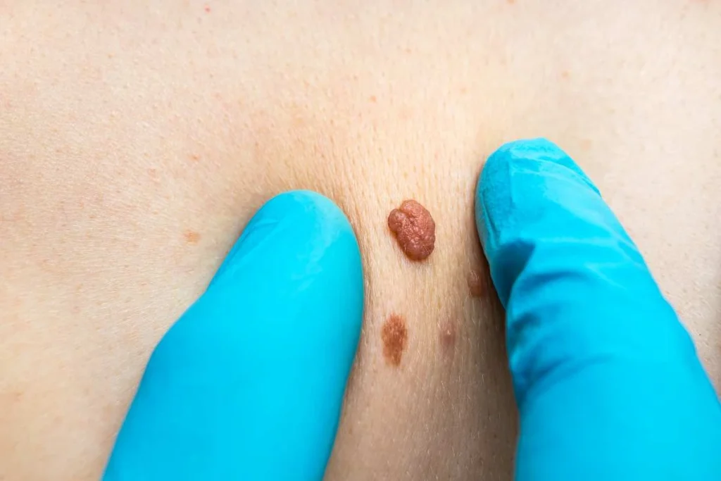 Consultant examining a skin tag Lyndhurst