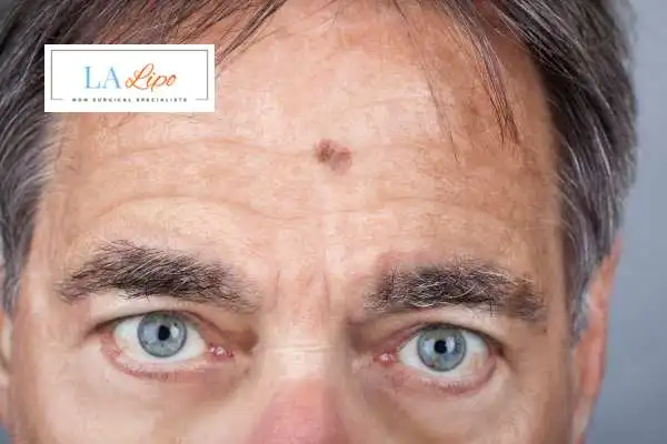 Solar Lentigo Removal Lyndhurst image of man with mark on his forehead