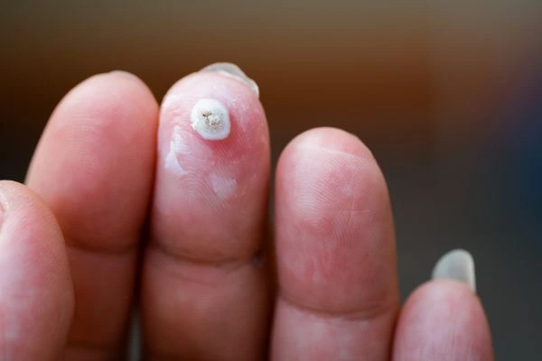 wart on person finger - cryotherapy to treat from LA LIPO Lyndhurst