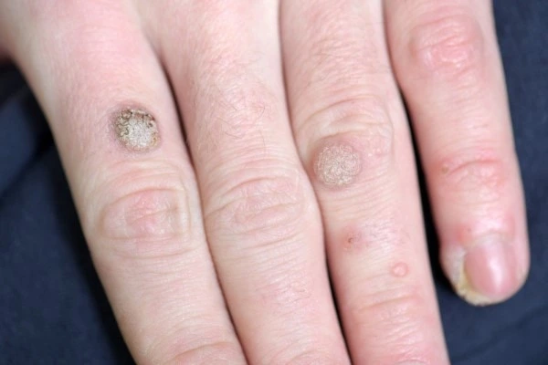photo of warts on person hand - see wart removal Lyndhurst from LA LIPO