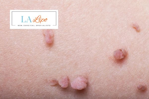 Does cryopen skin tag removal Lyndhurst hurt? Find out now call our team today!