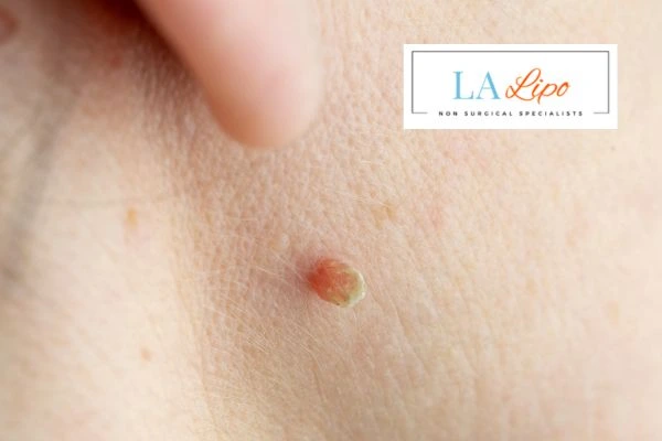 Book skin tag removal Lyndhurst today speak to our team now!