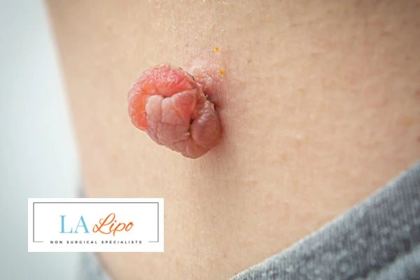 Interested in skin tag removal Lyndhurst? Concerned about the pain? Find out more today!