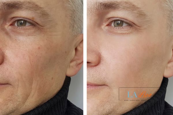 See the amazing results of Morpheus8 Treatment Lyndhurst!