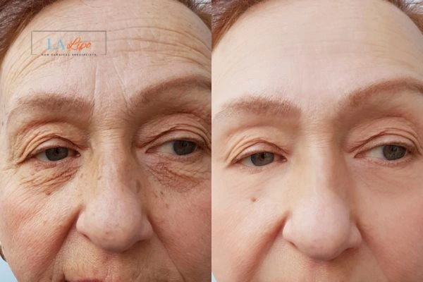 The powerful benefits of Morpheus8 Treatment Lyndhurst - Call Our team today!