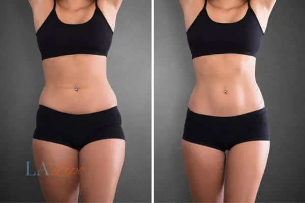 before and after results of non-surgical treatment to help a woman's body image and mental health Lyndhurst