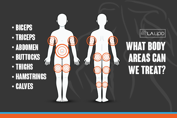 Diagram to show areas you can have LA-EMS Body Sculpting Treatment Lyndhurst