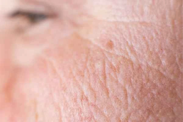 close up picture of a woman's face showing an age spot Lyndhurst