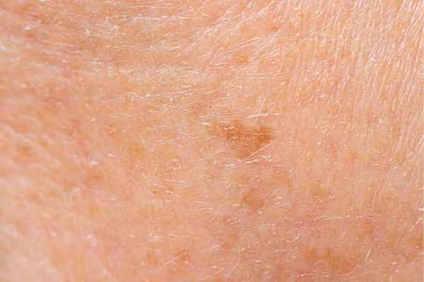 close up picture of age spots Lyndhurst