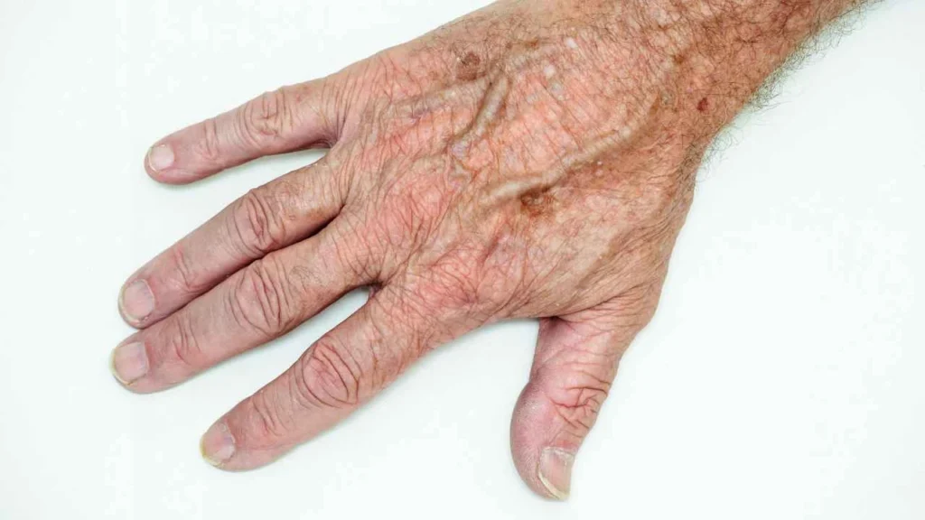 Male hand showing age spot Lyndhurst
