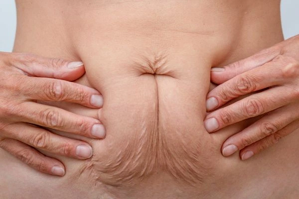 Image of a woman's stomach with loose skin - example of skin tightening Lyndhurst options