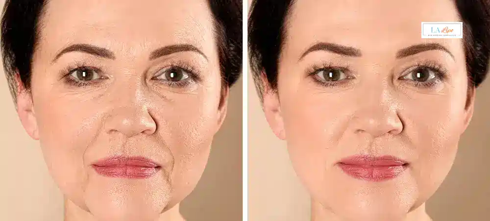 How Long Does It Take to See Results and How Long Do They Last Lyndhurst?