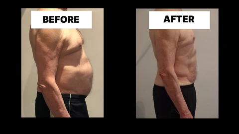 What Symptoms Can Diastasis Recti Cause in Men? Weak Core, Back Pain and Poor Posture Lyndhurst